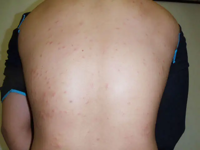 害獣駆除の消毒 虫刺され1