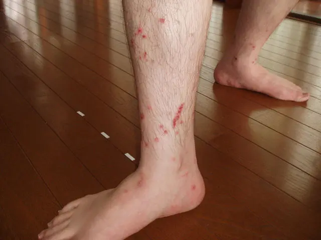 害獣駆除の消毒 虫刺され2